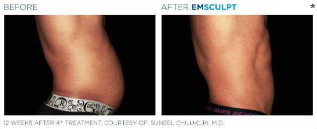 Before and After Photo of abdomen scultping Treatment in San Francisco